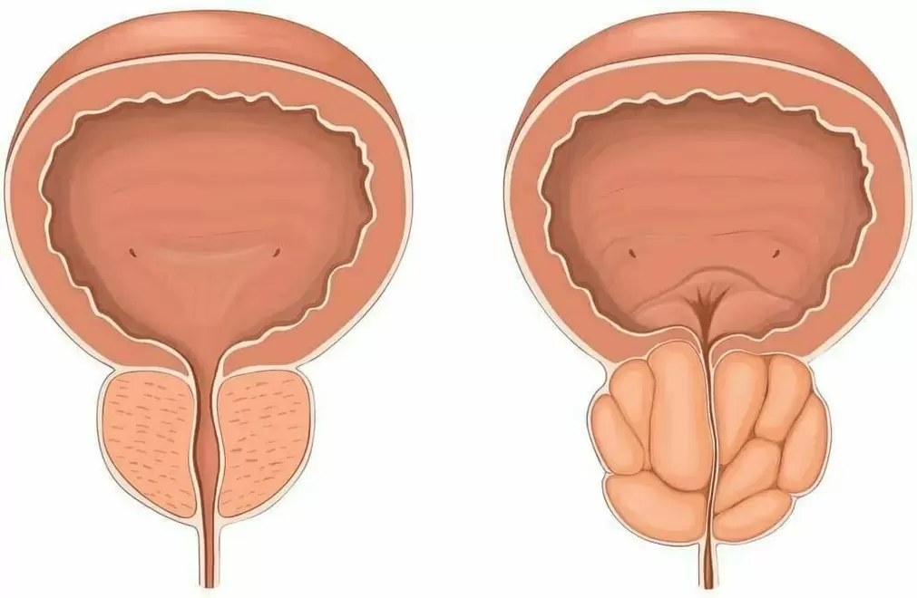 Gesunde Prostata und Prostatitis